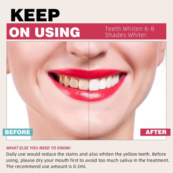 Teeth Whitening Kit with LED Lights Tray for Sensitive Teeth - Image 2